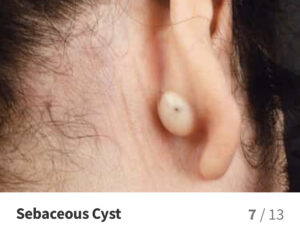 Skin Cyst