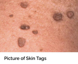 Skin Tags
